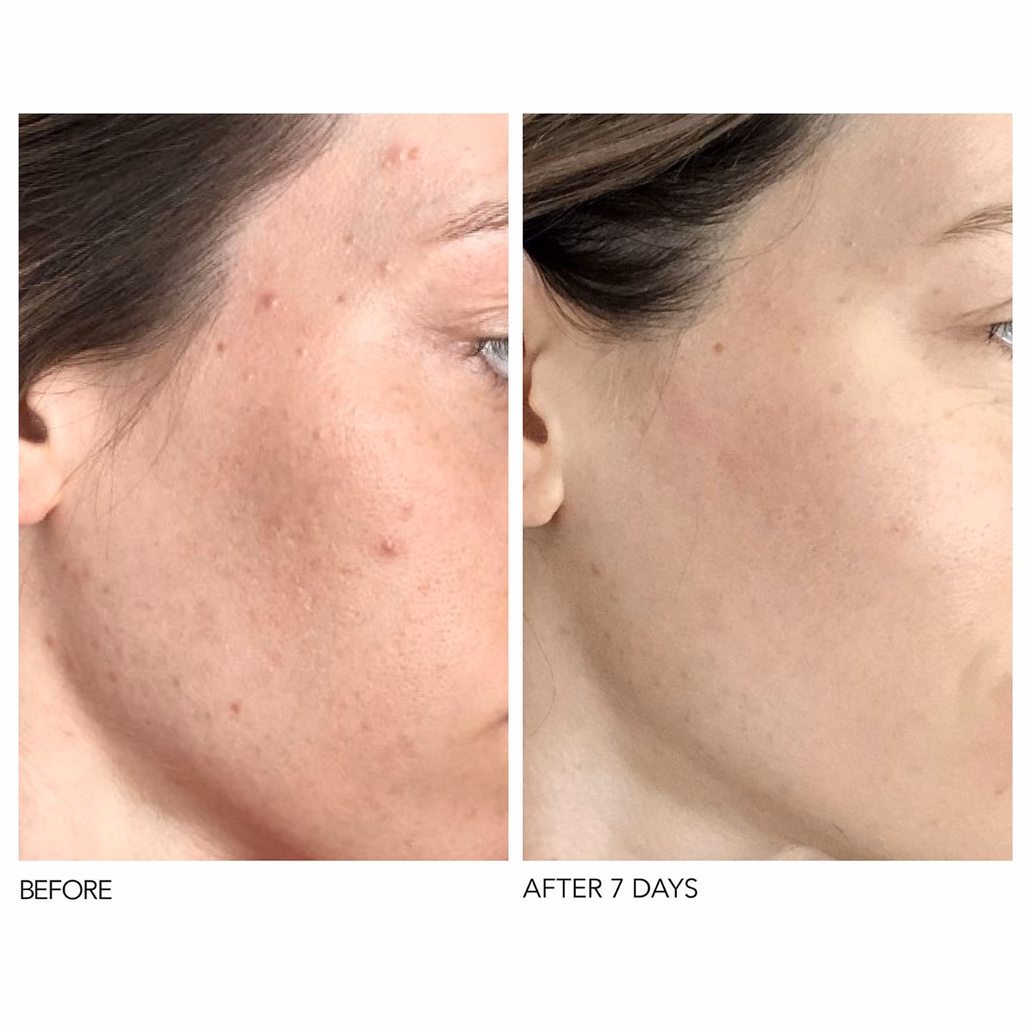 Alpha Beta? Universal Daily Peel 5 Pack