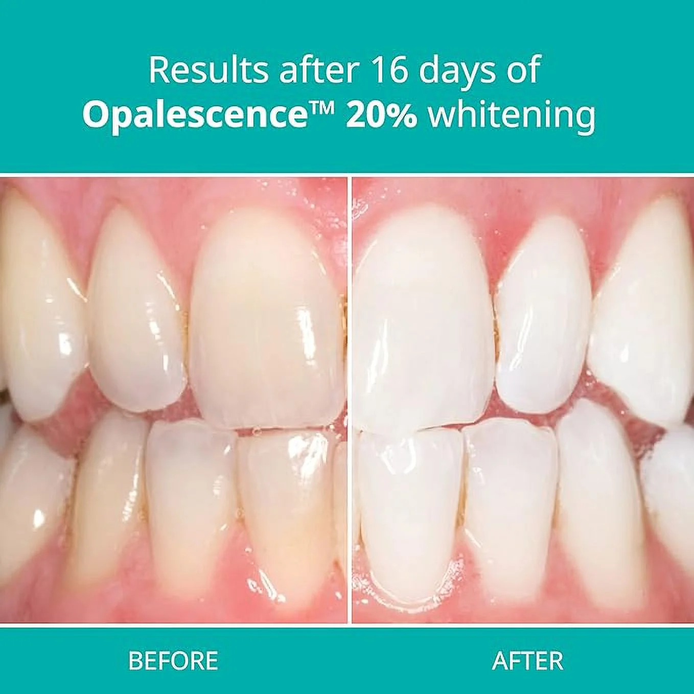 Opalescence 20% PF Mint Teeth Whitening Syringe Gel Refill Kit by Ultradent – Professional Dental Whitener (4 Syringes, Carbamide Peroxide Based)