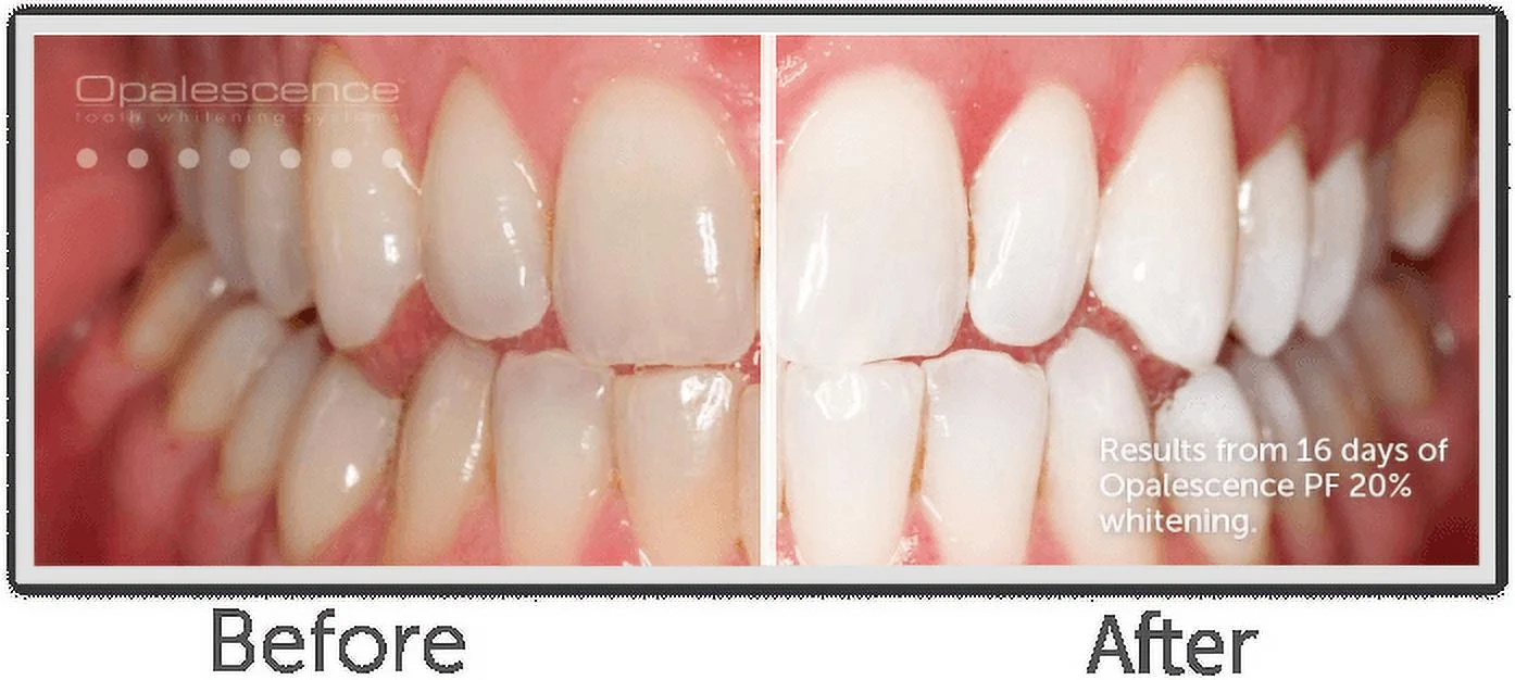 Opalescence PF 35% Maximum Strength Tooth Whitening Gel Kit - 8 Syringes with Custom Trays and Whitening Toothpaste