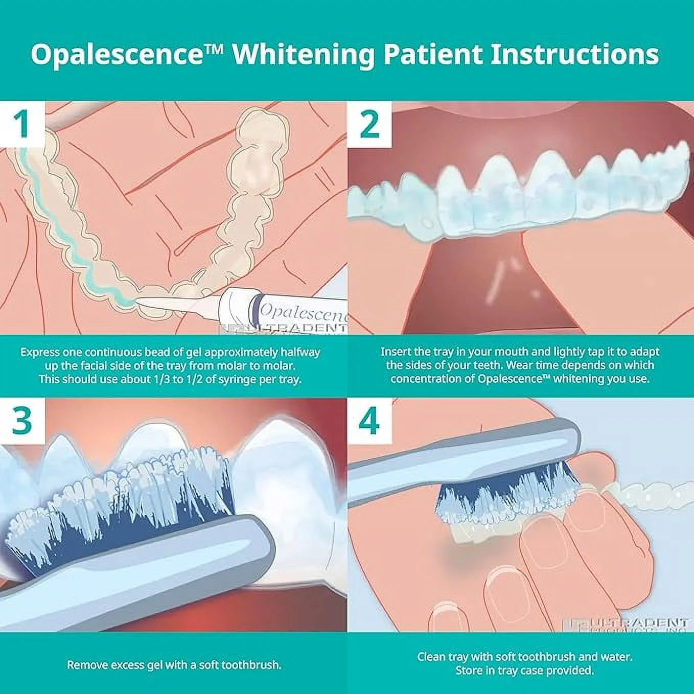 Opalescence 20% PF Mint Teeth Whitening Syringe Gel Refill Kit by Ultradent – Professional Dental Whitener (4 Syringes, Carbamide Peroxide Based)