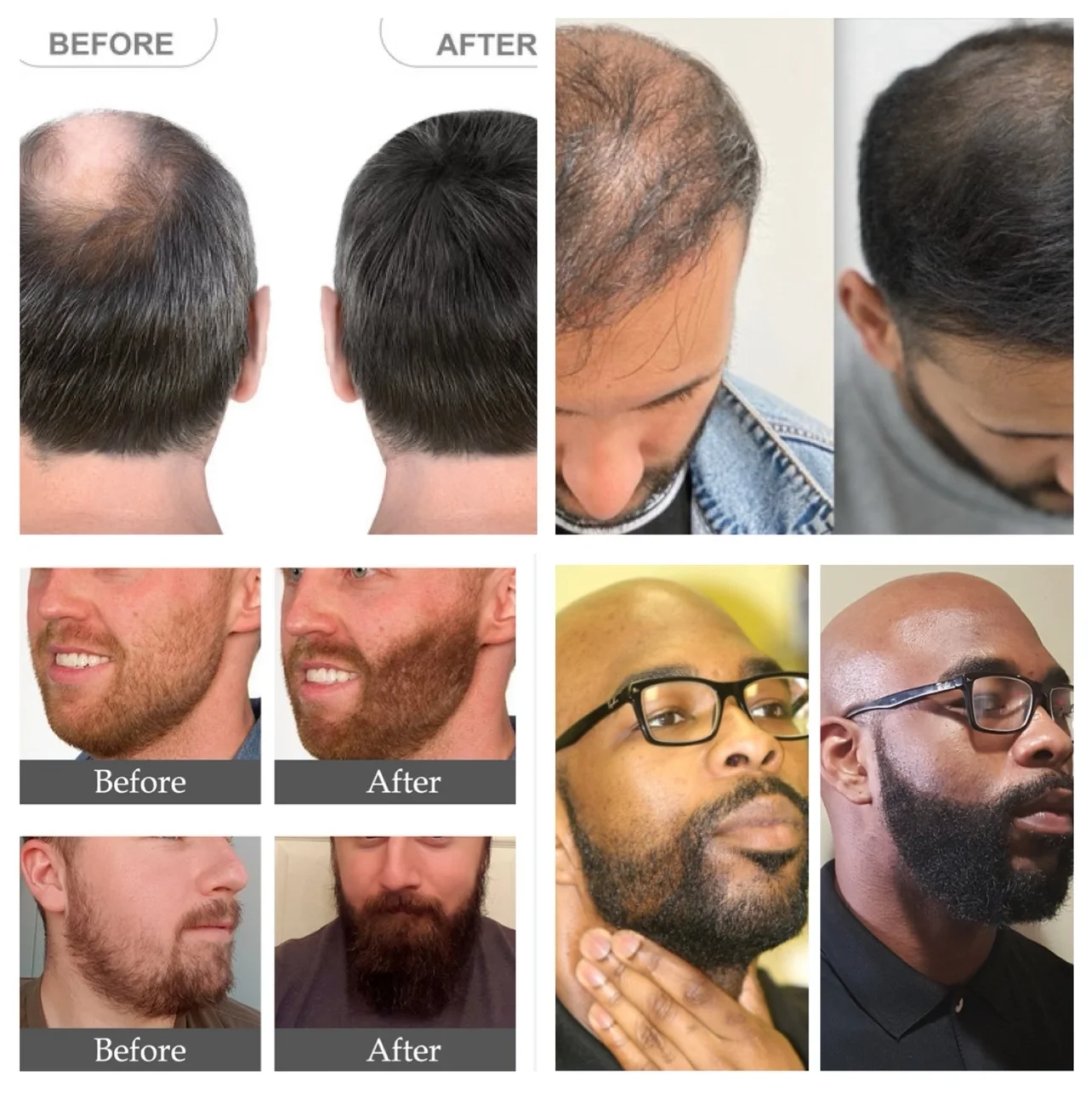 Minoxidil 5% Hair Regrowth Solution Extra Strength Men 6 Month Supply 3 BOTTLES