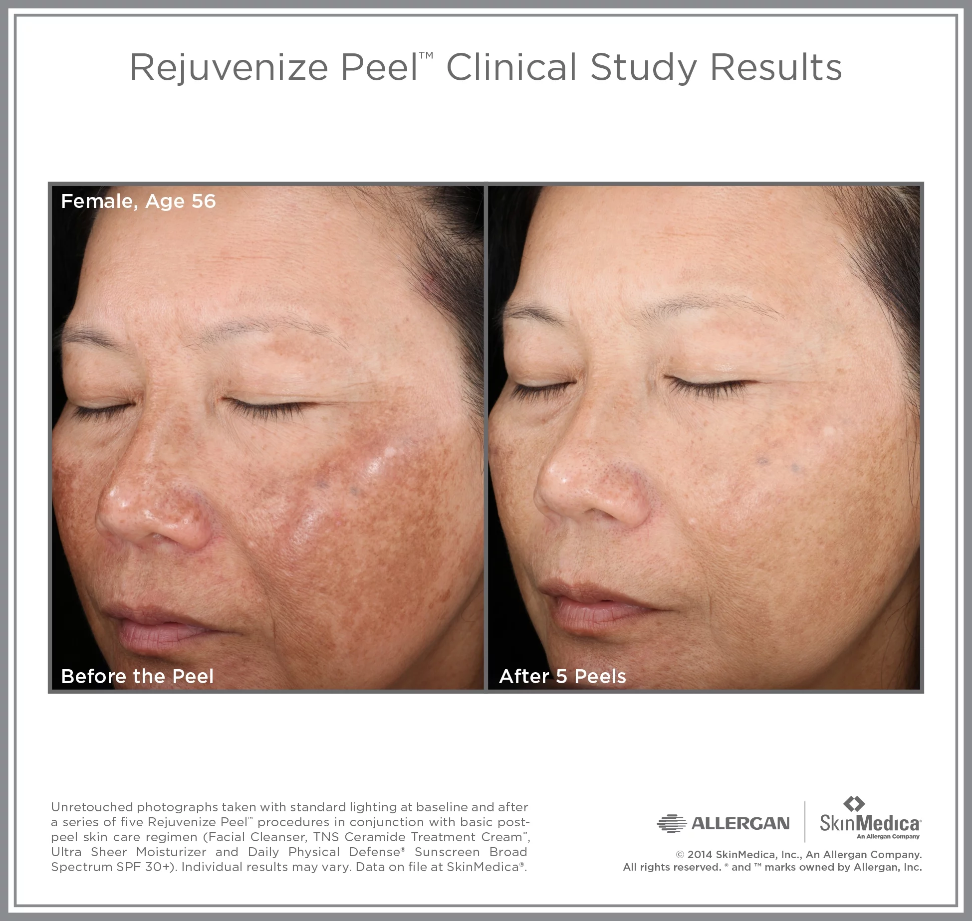 SkinMedica Illuminized Peel