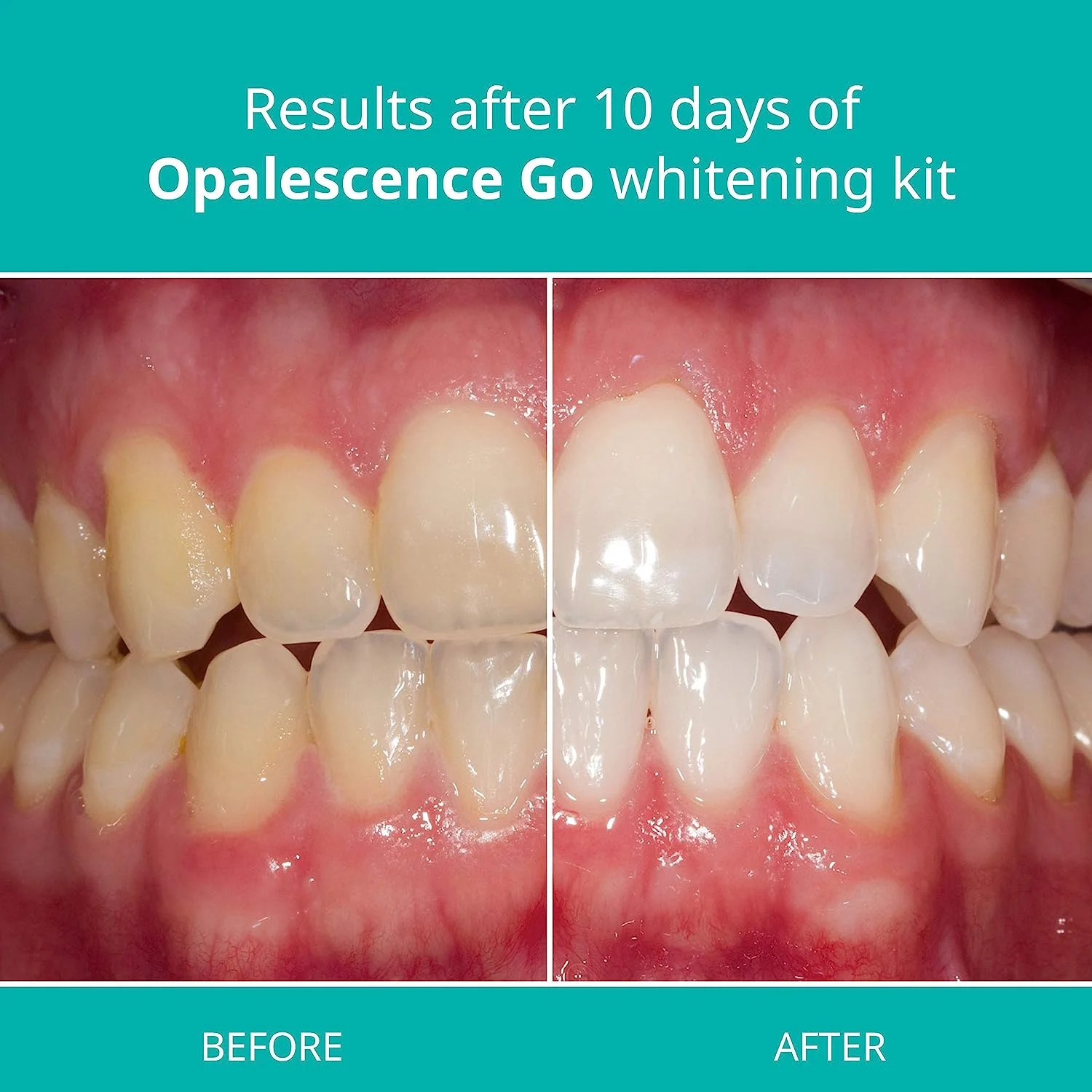 Opalescence Go 15% Prefilled Teeth Whitening Gel Trays (10 Treatments) Cool Mint Hydrogen Peroxide